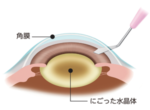 水晶体摘出1